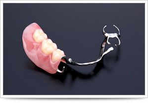 金属床義歯による修復